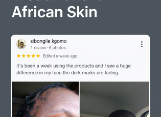 Before and after photos showing improvement in dark cheek pigmentation on a woman’s face after using skincare products, with a review saying the dark marks are fading.