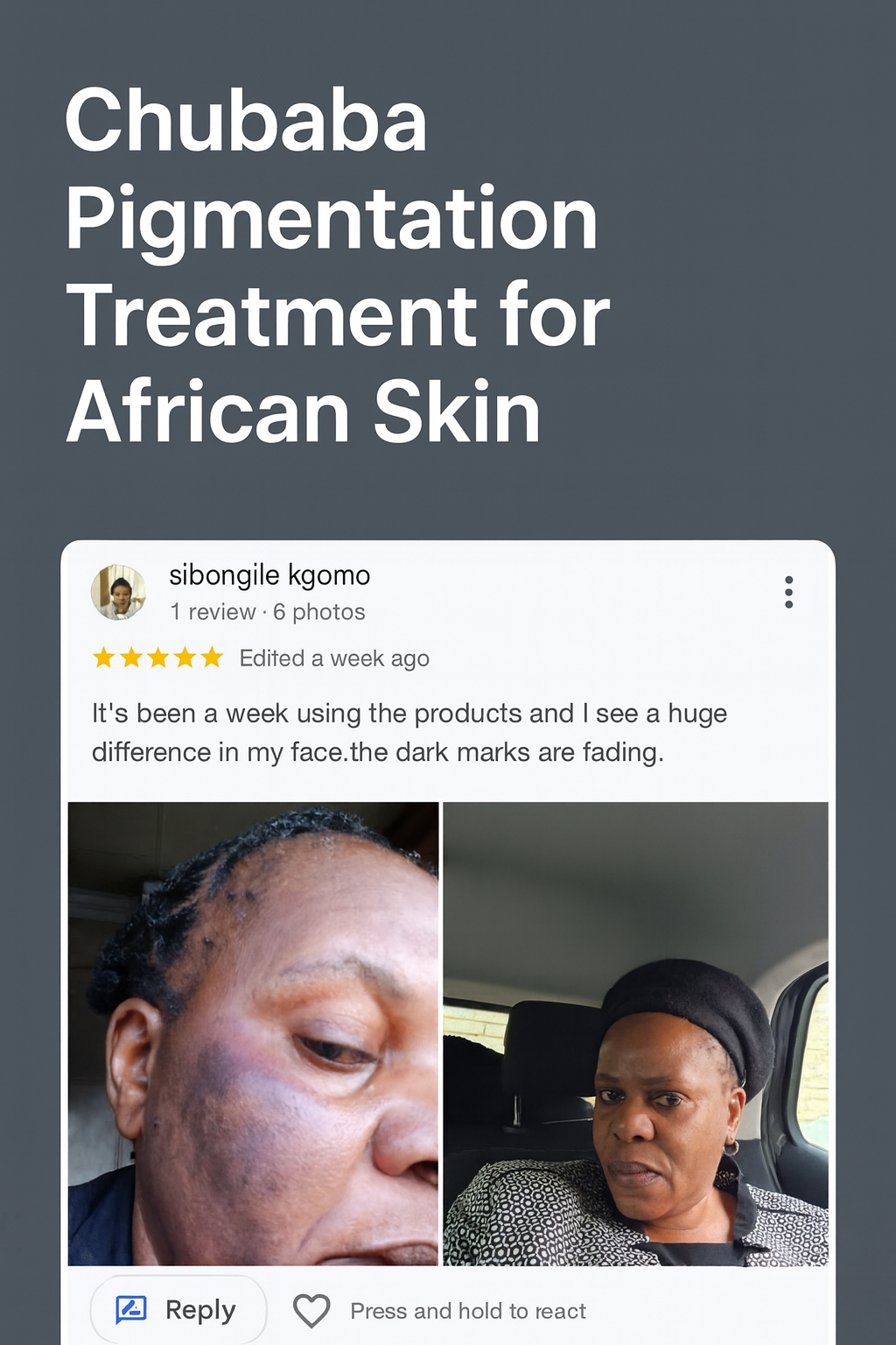 Before and after photos showing improvement in dark cheek pigmentation on a woman’s face after using skincare products, with a review saying the dark marks are fading.