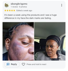 Before and after photos showing improvement in dark cheek pigmentation on a woman’s face after using skincare products, with a review saying the dark marks are fading.